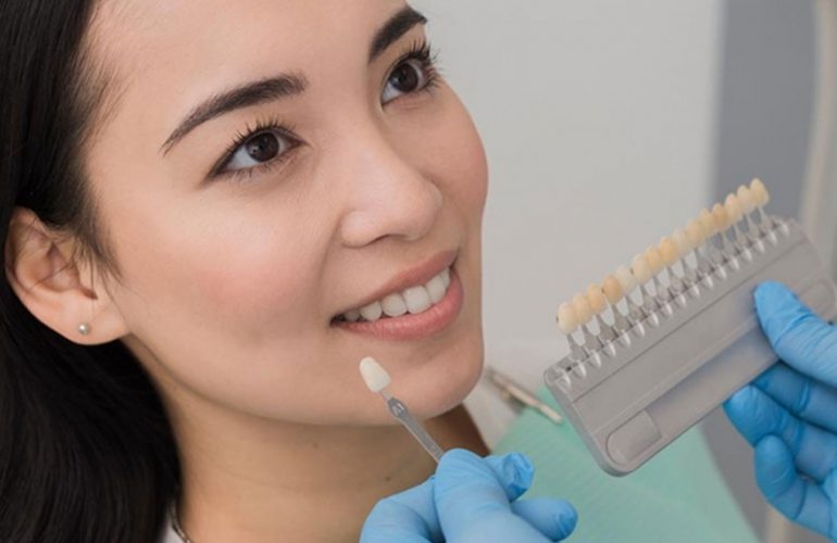 Shade-matching a patient's smile for veneers and cosmetic dentistry